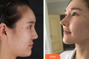 珠海陸達(dá)美容外科醫(yī)院劉仁和整形價格表附肋骨隆鼻案例展示