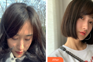 珠海陽光醫(yī)院整形美容中心易菲整形價格表附去痘印痘坑案例展示