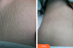 珠海陽光醫(yī)院整形美容中心張敏愛整形價格表附激光祛妊娠紋案例展示