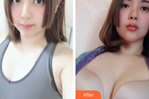 珠海新顏醫(yī)療美容診所朱占魁整形價格表附自體脂肪隆胸案例展示