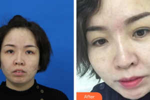 珠?；輴坩t(yī)院整形美容科陳曉華整形價格表附微針美膚案例展示