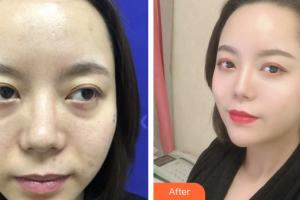 珠海科美醫(yī)療美容醫(yī)院李金瓊整形價格表附私人訂制童顏術(shù)基礎(chǔ)版案例展示