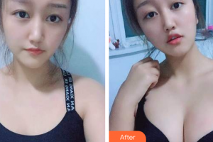 珠?？泼泪t(yī)療美容醫(yī)院張民望整形價格表附自體脂肪隆胸案例展示