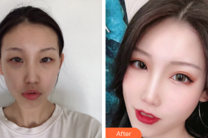 珠?？泼泪t(yī)療美容醫(yī)院金俊浩整形價格表附眼部整形案例展示