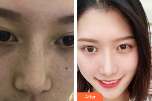 珠海萊茵醫(yī)療美容醫(yī)院崔俊溶整形價(jià)格表附祛斑祛痣案例展示