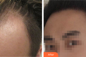 珠海萊茵醫(yī)療美容醫(yī)院李尚旭整形價(jià)格表附種植發(fā)際線案例展示