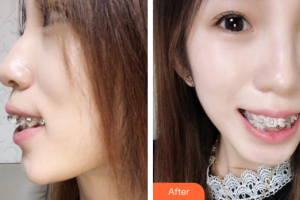 珠海陸達(dá)美容外科醫(yī)院程琦整形價(jià)格表附自鎖托槽矯正案例展示