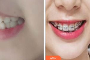 珠海陸達(dá)美容外科醫(yī)院曹宇整形價(jià)格表附自鎖矯正案例展示