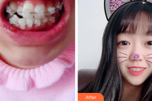 珠海陸達(dá)美容外科醫(yī)院何維森整形價(jià)格表附陶瓷矯正案例展示