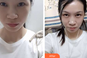 珠?；輴坩t(yī)院整形美容科羅艷紅整形價(jià)格表附眼部修復(fù)案例展示