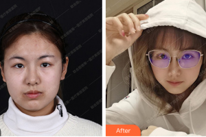 珠海微創(chuàng)外科醫(yī)院金涥澤整形價(jià)格表附切開雙眼皮案例展示