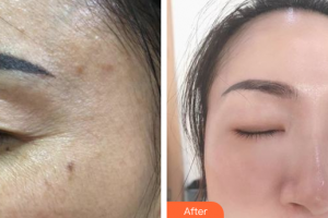 珠海韓妃醫(yī)療美容門診部李友良整形價格表附超激光美膚祛斑案例展示