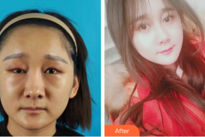 珠海吉大郭閆伏醫(yī)療美容診所張明興整形價格表附鼻部手術(shù)+埋線提升案例展示