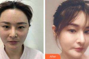 珠海吉大郭閆伏醫(yī)療美容診所薛博今整形價格表附埋線提升案例展示