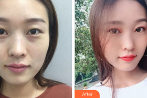 珠海韓妃醫(yī)療美容門診部項曉飛整形價格表附鼻部手術(shù)案例展示