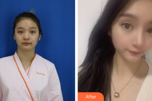 珠海艾瑞醫(yī)療美容醫(yī)院余昌勝整形價格表附鼻部手術(shù)案例展示