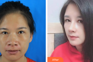 珠海艾瑞醫(yī)療美容醫(yī)院伍展立整形價格表附鼻部手術(shù)案例展示