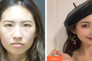 珠海藝星（原仁愛）醫(yī)療美容門診部潘智軒整形價格表附鼻部多項案例展示