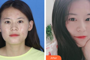 珠海蒂伊醫(yī)療美容門診部林戈亮整形價格表附微針祛痘案例展示