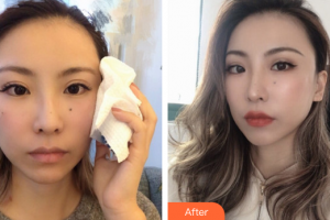 珠海蒂伊醫(yī)療美容門診部李宜欣整形價格表附埋線提升案例展示