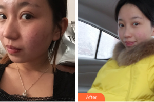 珠海愛思特醫(yī)療美容醫(yī)院李晶整形價格表附光子嫩膚案例展示