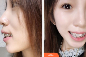 珠海拜博口腔醫(yī)院賴春光整形價格表附自鎖托槽矯正案例展示