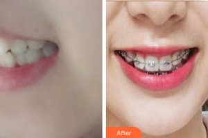 珠海拜博口腔醫(yī)院吳曉飛整形價格表附自鎖矯正案例展示