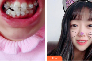 珠海拜博口腔醫(yī)院葉瀚整形價格表附陶瓷矯正案例展示