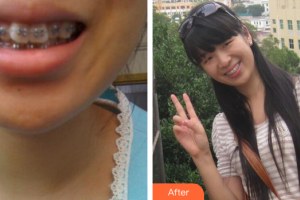 珠海拜博口腔醫(yī)院付冬整形價格表附金屬矯正案例展示