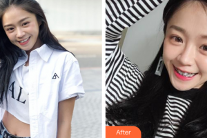 珠海拜博口腔醫(yī)院曾皓整形價格表附金屬矯正案例展示