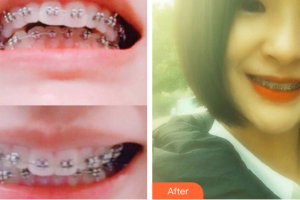 珠海拜博口腔醫(yī)院秘雙燕整形價格表附金屬矯正案例展示