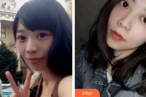 珠海拜博口腔醫(yī)院韓德志整形價格表附自鎖矯正案例展示