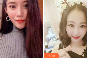 珠海拜博口腔醫(yī)院黃東整形價格表附超聲波洗牙案例展示