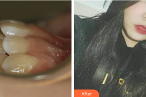 珠海拜博口腔醫(yī)院彭德浩整形價格表附隱適美矯正案例展示