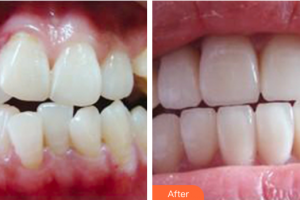 珠海拜博口腔醫(yī)院張勁波整形價格表附口腔牙齒矯正案例展示