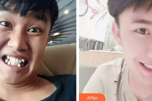 珠海拜博口腔醫(yī)院譚澤深整形價格表附金屬矯正案例展示