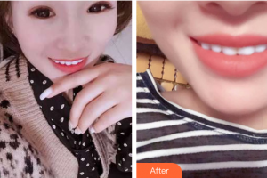 珠海拜博口腔醫(yī)院馮慧韻整形價格表附冷光美白案例展示