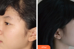 珠海拜博口腔醫(yī)院解淼整形價格表附自鎖矯正案例展示