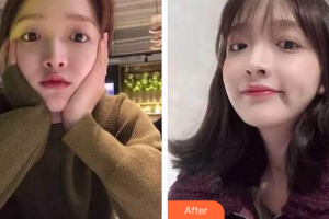 珠海拜博口腔醫(yī)院徐承磊整形價格表附超聲波潔牙案例展示