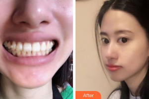 珠海拜博口腔醫(yī)院程峰整形價格表附隱形矯正案例展示