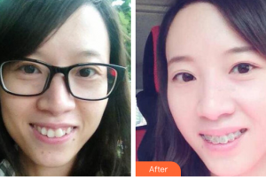 珠海六合口腔門診部黎文明整形價格表附自鎖托槽矯正案例展示