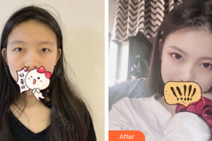 遵義醫(yī)科大學第五附屬（珠海）醫(yī)院整形燒傷手外科陳世玖整形價格表附全切雙眼皮案例展示