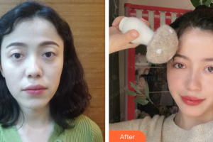 珠海雅媛醫(yī)療美容門診部張志欣整形價格表附眼部綜合案例展示