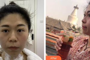 珠海藝星（原仁愛）醫(yī)療美容門診部羅家寧主診醫(yī)師整形價格表附熱瑪吉抗衰案例展示