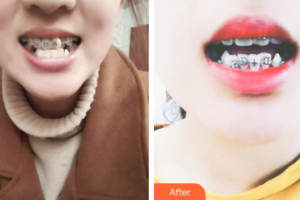 珠海美南華醫(yī)療美容醫(yī)院嚴擁整形價格表附金屬矯正案例展示