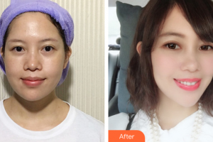 珠海美南華醫(yī)療美容醫(yī)院石顯文整形價格表附	超激光美膚祛斑案例展示