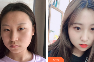 汕頭伊麗莎白整形美容醫(yī)院張紅軍整形價格表附埋線提升案例展示