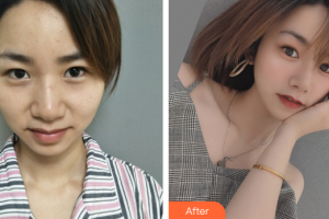 汕頭名流整形美容醫(yī)院李增貴整形價格表附眼部整形案例展示