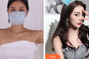 汕頭名流整形美容醫(yī)院余良雄整形價格表附手臂吸脂案例展示