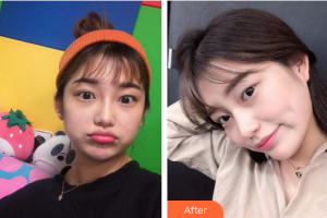 汕頭名流整形美容醫(yī)院張燕香整形價格表附光子嫩膚案例展示